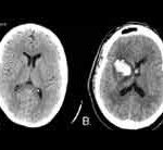 acidente_vascular_cerebral